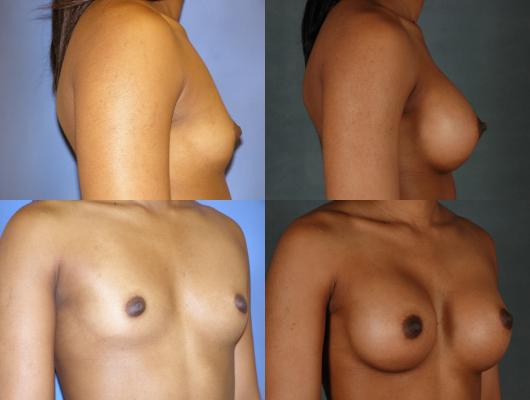 breast-augmentation-p18_uIYztsw.jpg