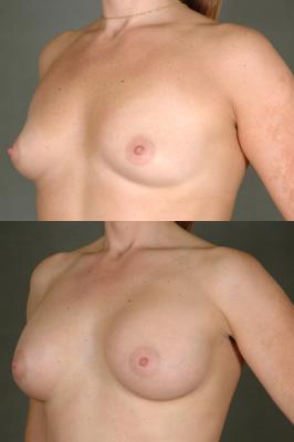 breast-augmentation-p1_SMuj19e.jpg