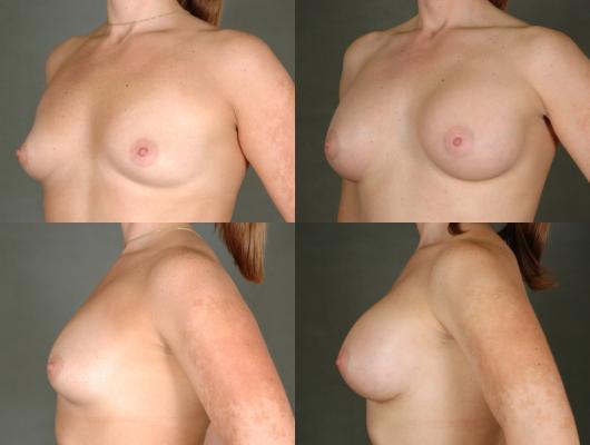 breast-augmentation-p1_sFlX0Of.jpg