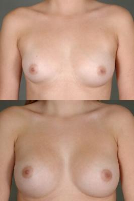 breast-augmentation-p24.jpg