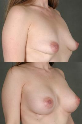 breast-augmentation-p25_uTtHXud.jpg