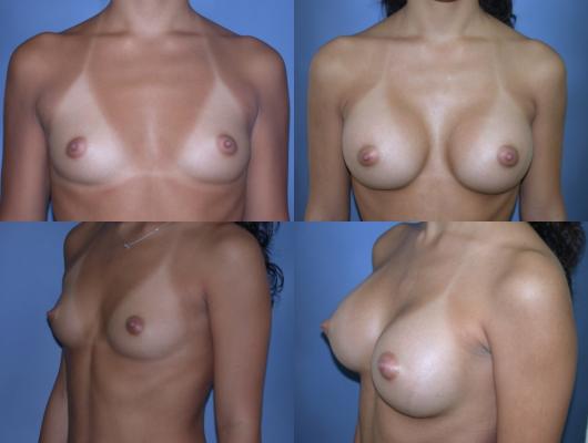 breast-augmentation-p27_09OPMzG.jpg