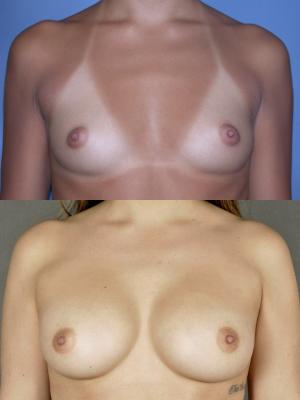 breast-augmentation-p27_uHHkJ4q.jpg