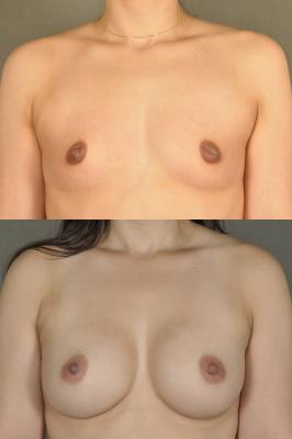 breast-augmentation-p28.jpg