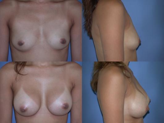 breast-augmentation-p29.jpg