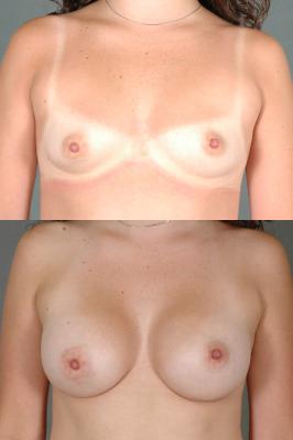 breast-augmentation-p35.jpg