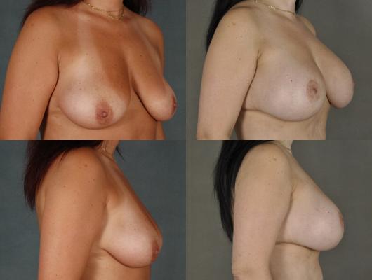 breast-augmentation-p5_2m2GLlz.jpg