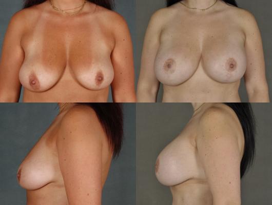 breast-augmentation-p5_UAajfUj.jpg