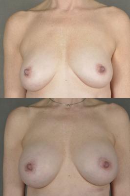 breast-augmentation-p7.jpg
