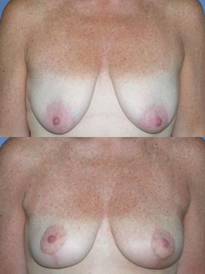 breast-lift-p1.jpg