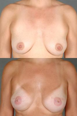 breast-reconstruction-and-tissue-expanders-lip-p20.jpg