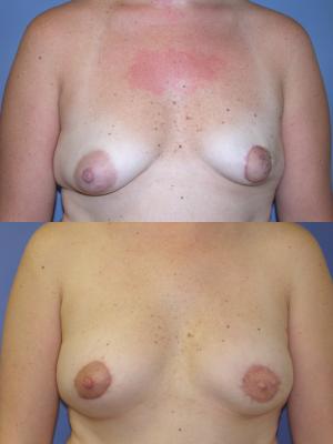 breast-reconstruction-p1.jpg