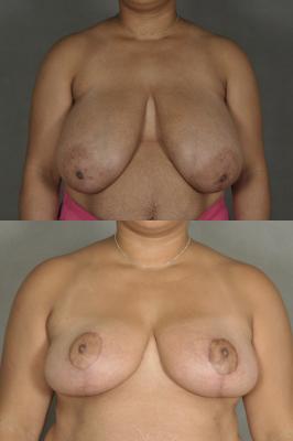 breast-reduction-p29.jpg