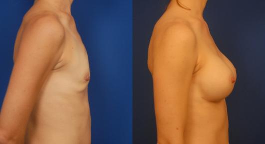 breast_implants_2.jpg