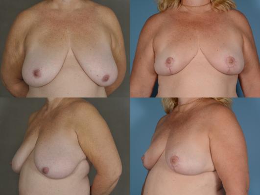 breastreduction1_ceqghZC_YwfB1Om.jpg