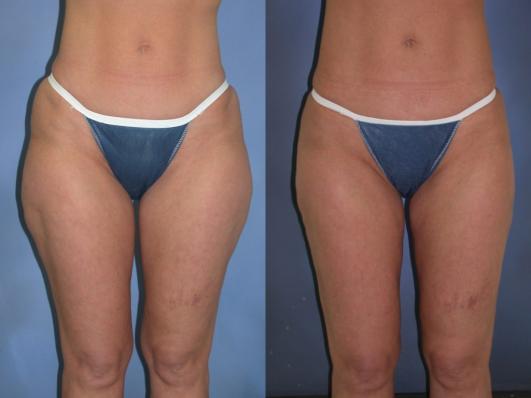 liposuction-p3.jpg