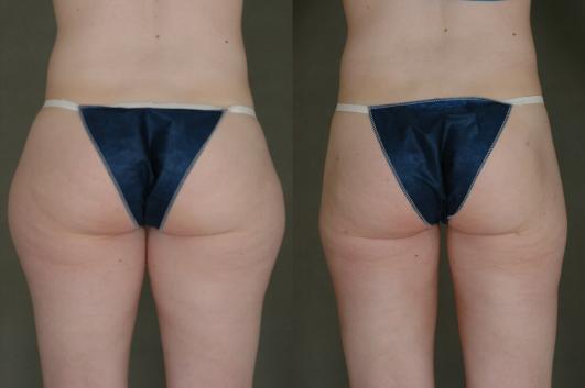 liposuction-p6_rJWeX8D.jpg