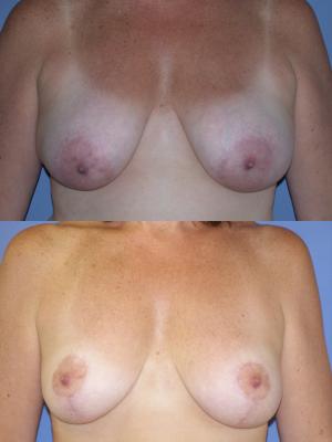 mommy-makeover-breast-lift-and-tummy-tuck-p1_lHJkQQO.jpg