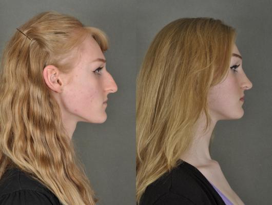 nose-rhinoplasty-p5_Ypi04Bg.jpg