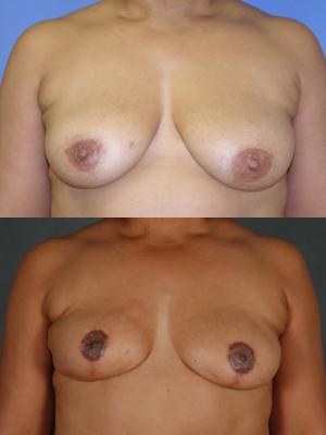 tram-flap-breast-reconstruction-and-tummy-tuck-p1_OwsiV7w.jpg