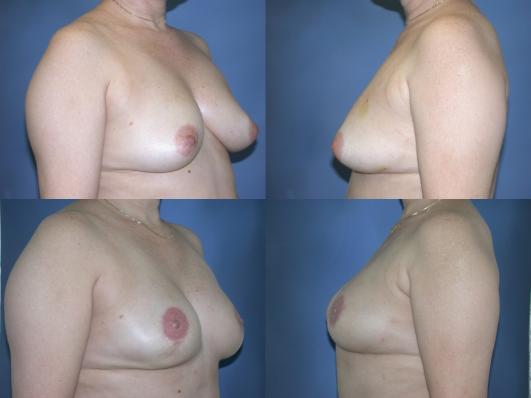 tram-flap-breast-reconstruction-p14_1URZVj0.jpg