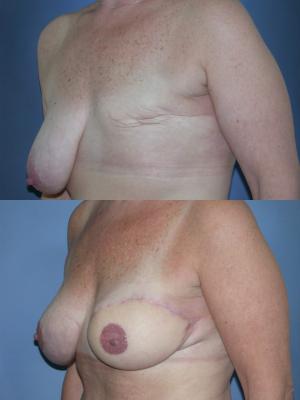tram-flap-breast-reconstruction-p29_97YLfMv.jpg