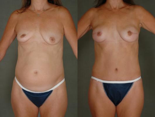 tram-flap-breast-reconstruction-p7.jpg