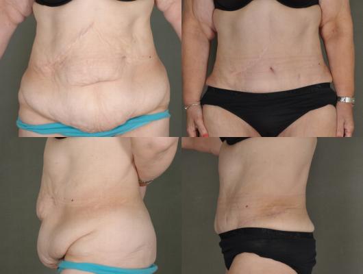 tummy-tuck-and-liposuction-p7.jpg