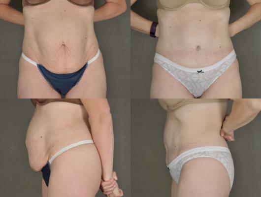 tummy-tuck-and-liposuction-p8_HOe1zaQ.jpg
