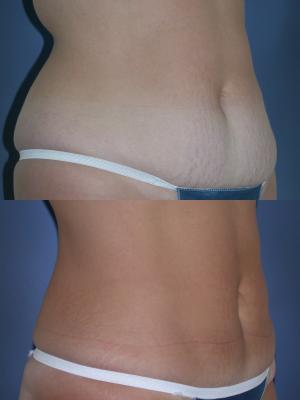 tummy-tuck-p1_4B6hxej.jpg