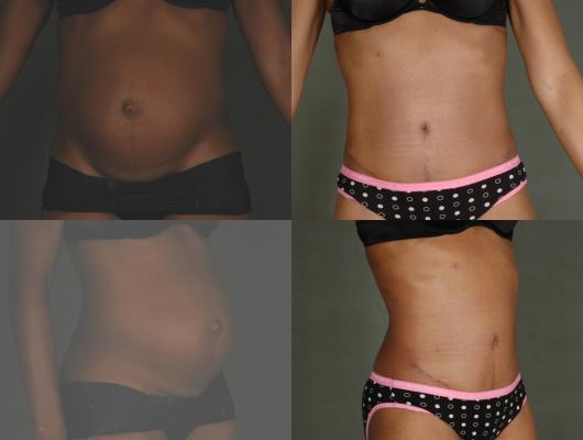tummy-tuck-p6_f6GDJQB.jpg